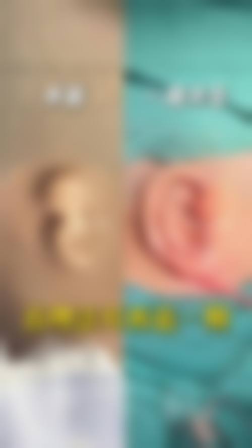 张正文传统Nagata法耳再造