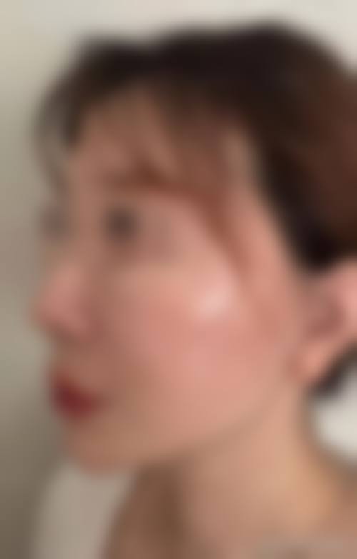 刘金超院长做拉皮手术技术牛，SMAS深层提升+隐痕切口，术后自然年轻不僵硬