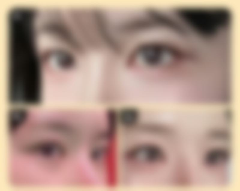 杭州薇琳温科磊双眼皮做的超好看，闭眼无痕还能定制专属原生感美眼！