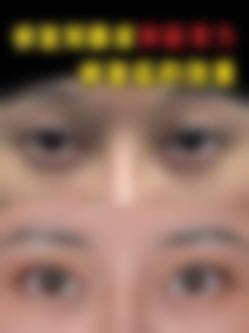 杜园园医生双眼皮修复价格分析