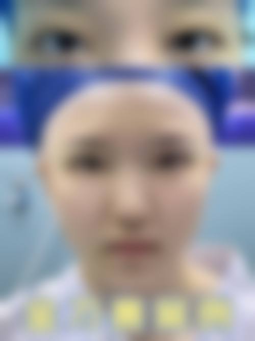 找杜园园做双眼皮修复去哪个医院？首选上海爱尚丽格，她专攻高难度眼修复口碑爆棚