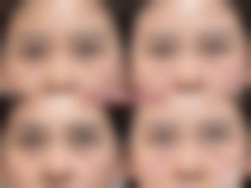 深圳健丽去眼袋效果怎么样？不开刀去眼袋成效显著，术后无疤恢复快获众多好评