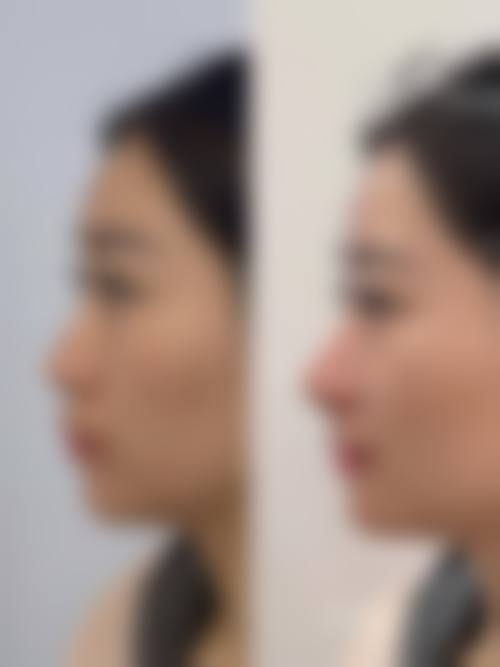 广州高尚医学美容中 心唇二期修复:余医生的不错技术