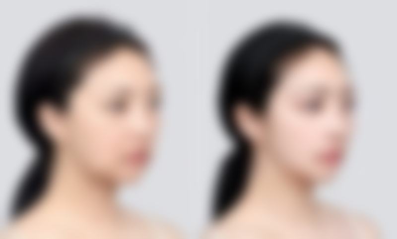 重庆瑞俪整形医院真实实例