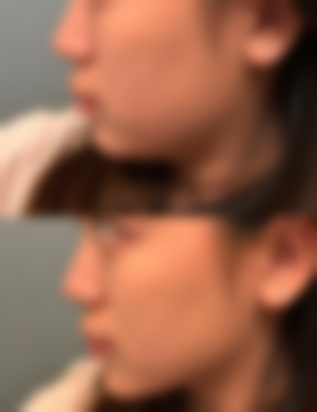 阴道紧缩针的成效与作用