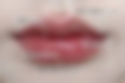 李挺医生在会阴撕裂修复上的优势