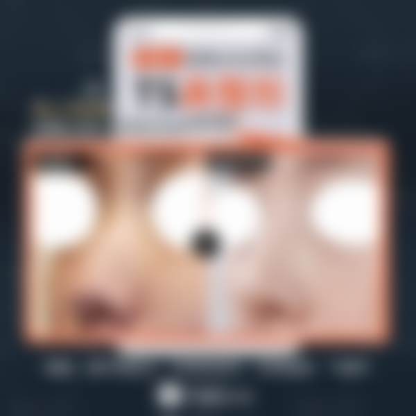 手术进行：韩国TS整形医院眼部整形修复成功实例之手术经历