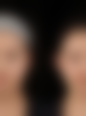 许昌市人民医院(整形美容科)真实实例