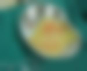 预防注射隆胸变硬的建议