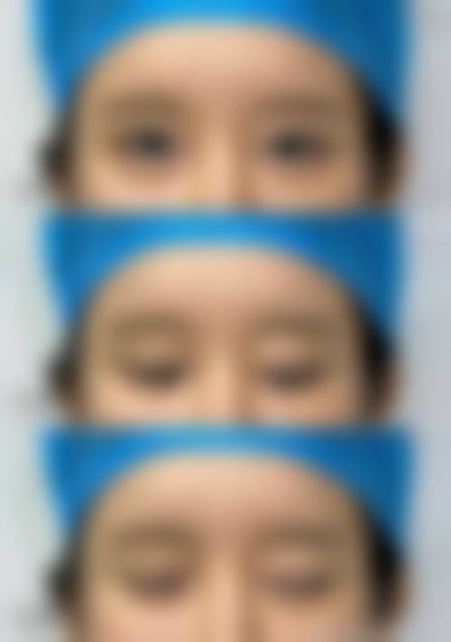 三、西宁开双眼皮医院的医生团队