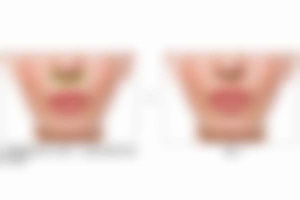 在北京蕾士悦容找张兵医生做玻尿酸注射，调鼻基底+唇部，审美在线无推销体验感拉满