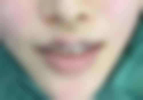 唇腭裂免费手术申请注意事项有哪些