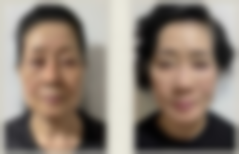 王乙立医生无痕筋膜提升技术