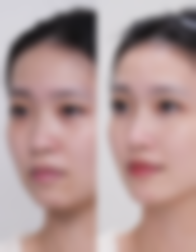 影响3D生物束带紧缩术维持时间的个体差异因素