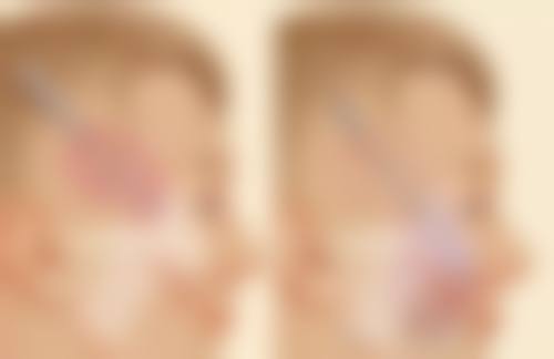 邓娟娟医生私密紧缩技术优势