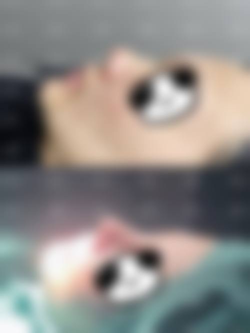 张鹏浩医生的核心隆鼻技术