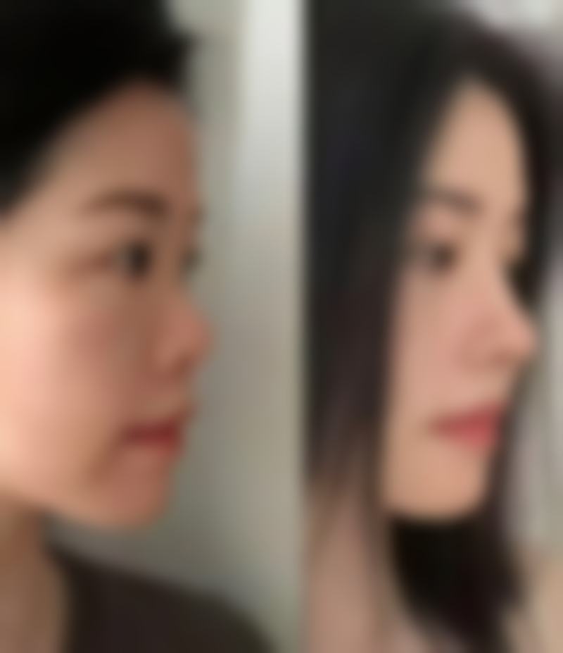 邓娟娟医生小阴唇精细化雕刻特色