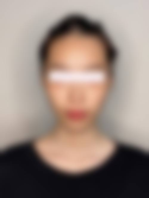 朱乐林磨骨风格保守，主打保留原生颌面特色，塑造自然和谐妈生脸型