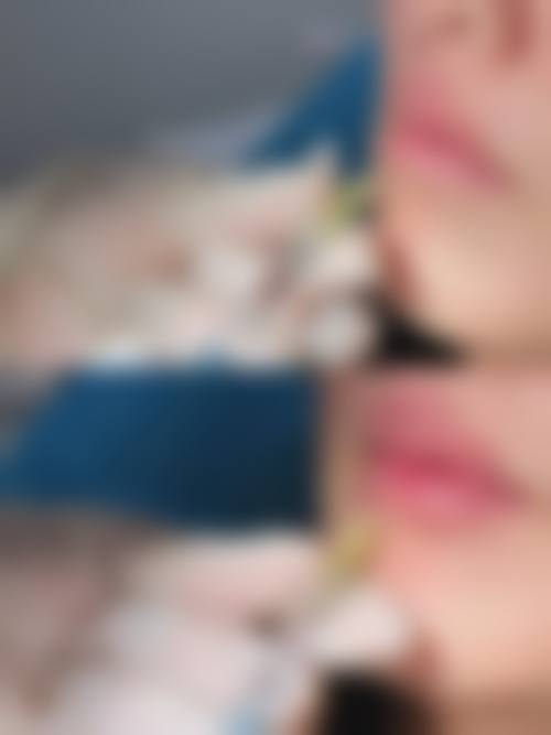 温州医 科 大学附属第一医院小拉皮手术术后护理费用