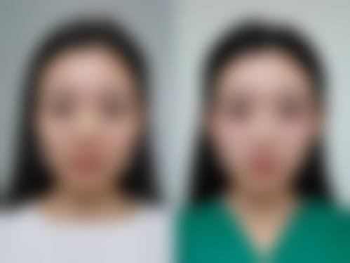 温州医 科 大学附属第一医院小拉皮手术与其他整形项目搭配收费