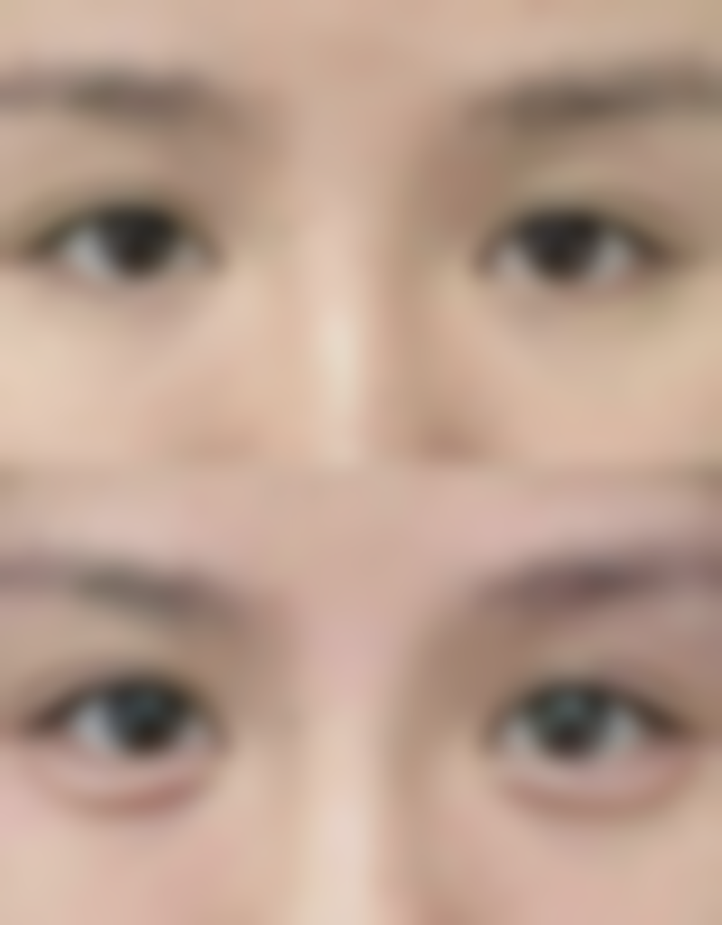 温州医 科 大学附属第一医院小拉皮手术联合颈部紧致收费