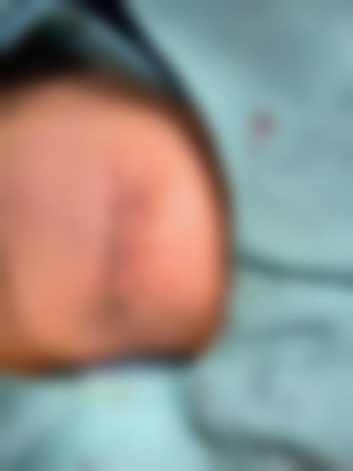 杨东运个性化疤痕修复方案