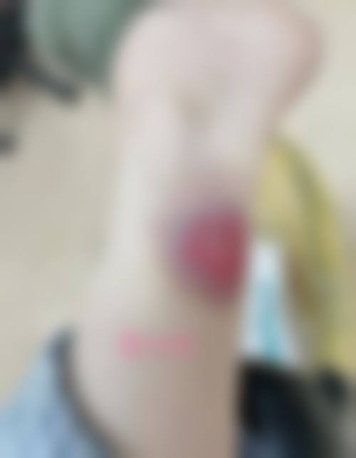 杨东运，疤痕修复界的“拆弹专家”｜靠精细缝合术搞定各类顽固疤痕