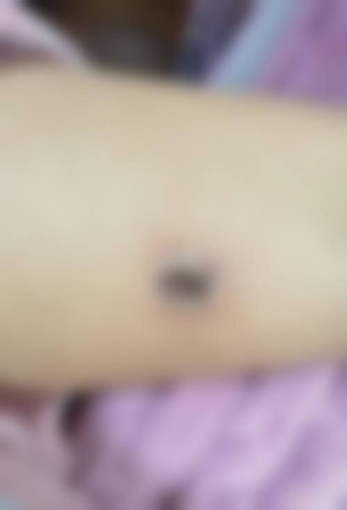 杨东运擅长的疤痕修复项目