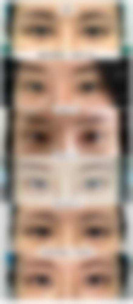 成都刘辅蓉双眼皮修复价格表公开，肉条修复5500元起，显微精雕疤痕淡