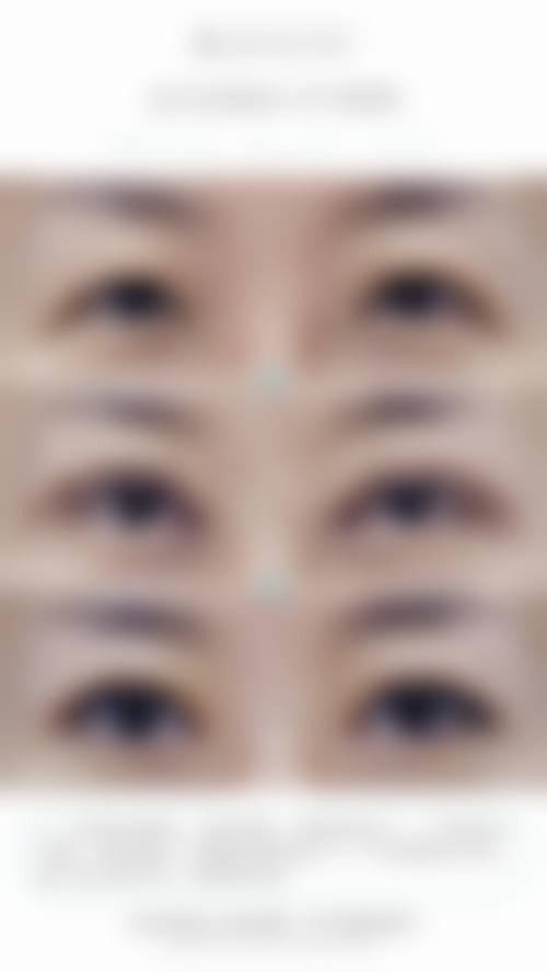 成都刘辅蓉双眼皮不对称修复价格详情