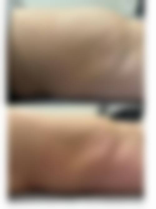 韩国inmode瘦身与其他瘦身方法对比