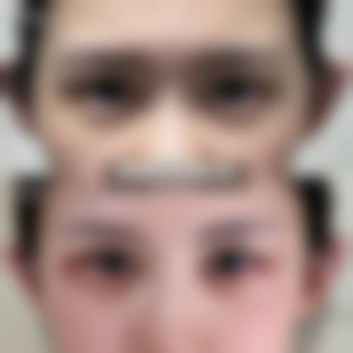 成都刘辅蓉上睑下垂修复价格参考