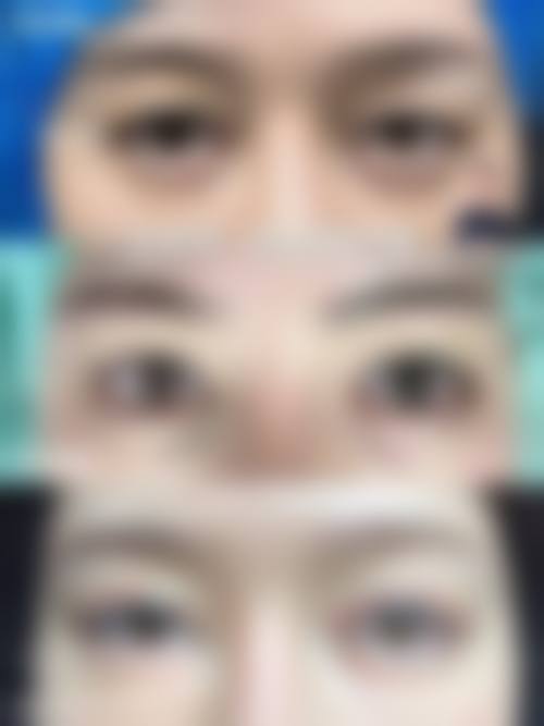 成都刘辅蓉眼袋复发修复价格范围