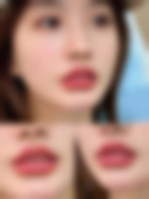 五、盐城响水莳月时光整形医院真实实例参考