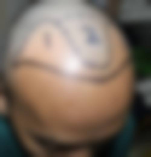 不同植发技术与剃头的关系