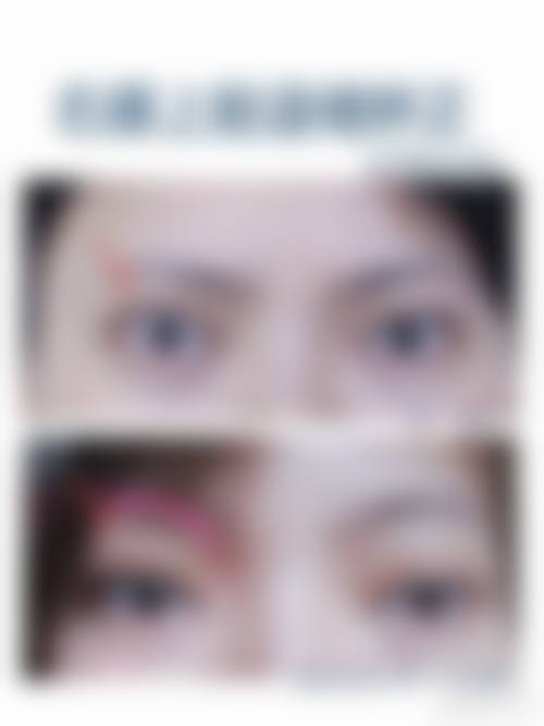 全切双眼皮修复的成效评估