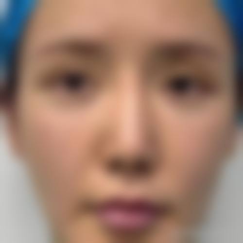 全切双眼皮修复的注意事项