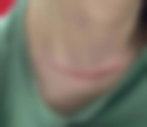 疤痕长疙瘩是否会越长越多