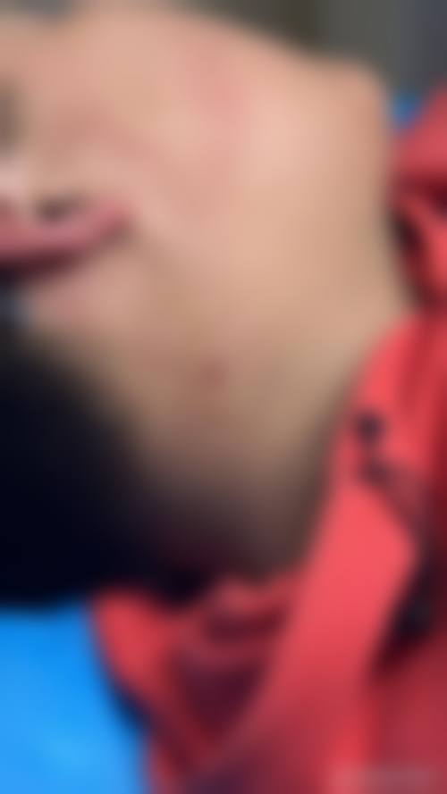 疤痕长疙瘩的日常护理