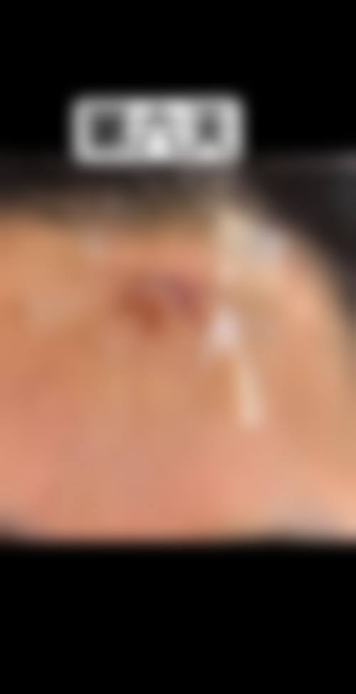 疤痕长疙瘩的危害