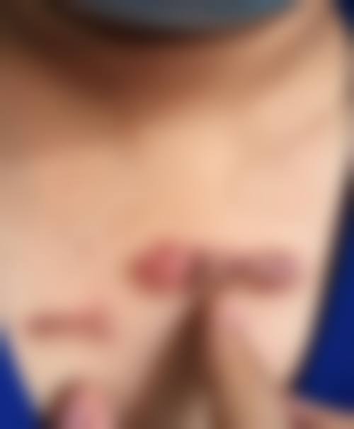 内眼角括号型疤痕的药物治疗