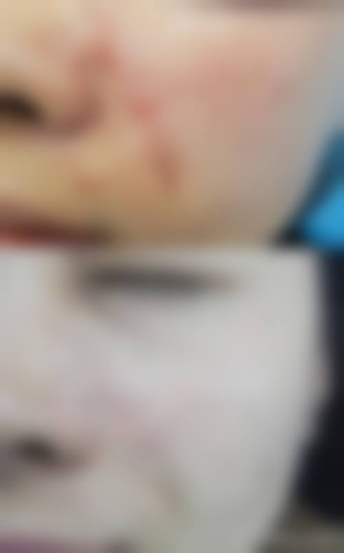 内眼角括号型疤痕的手术治疗