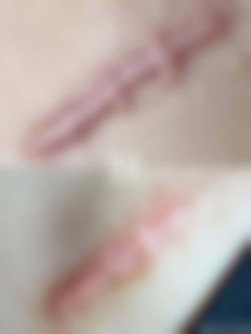 内眼角括号型疤痕怎么修复？激光、手术、填充等多种治疗方案为你揭晓