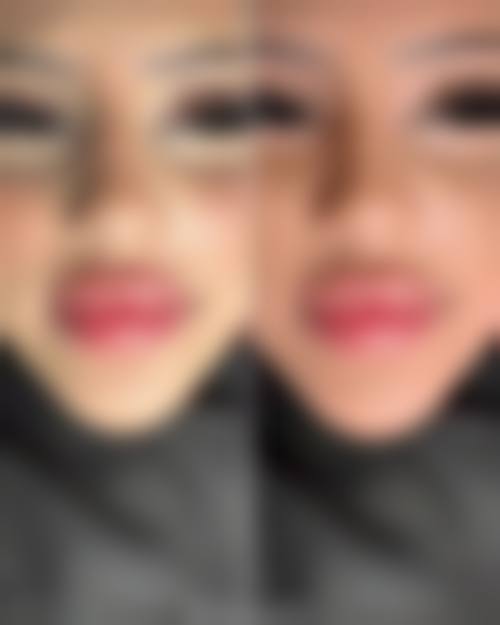 胸部整形：专精医生塑造理想胸型