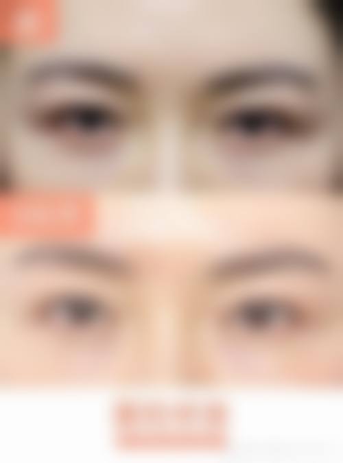 怎么把眼睛睡成双眼皮：长期习惯养成