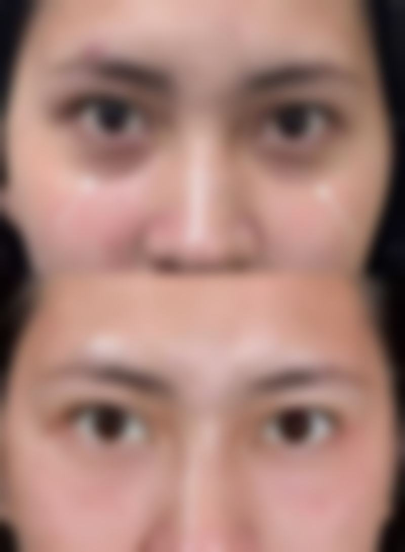 外切眼袋可能出现的危害之眼睑外翻