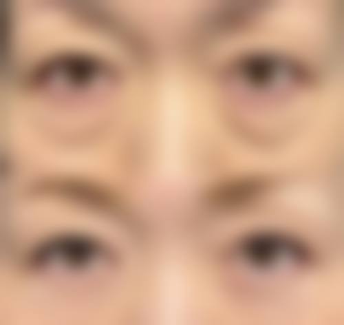 药物治疗去除长期下眼袋