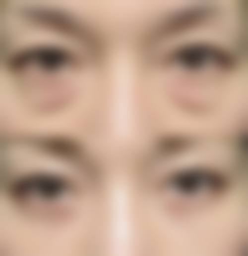 调整生活方式去除长期下眼袋