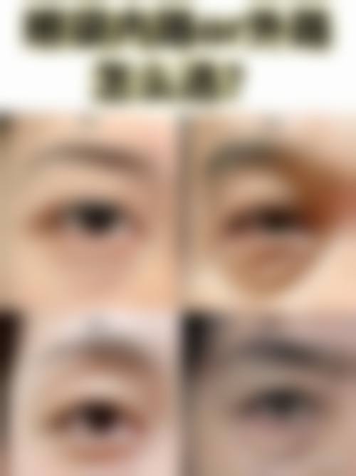 物理治疗去除长期下眼袋