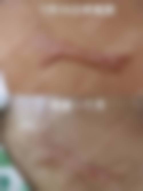 唇裂手术后医院推荐的疤痕护理及治疗
